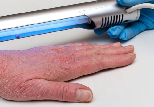 The Benefits and Risks of UV Light Therapy: An Expert's Perspective