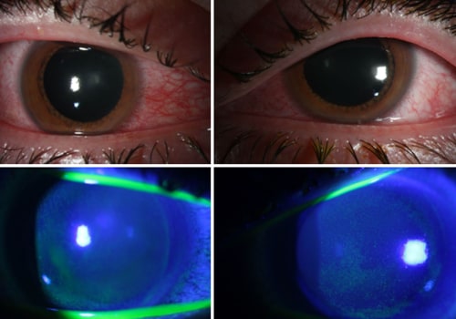 What is the Safe Exposure to UV Light? - An Expert's Perspective